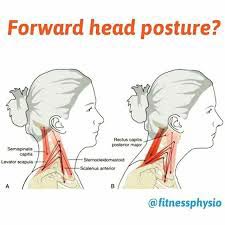 Forward head posture